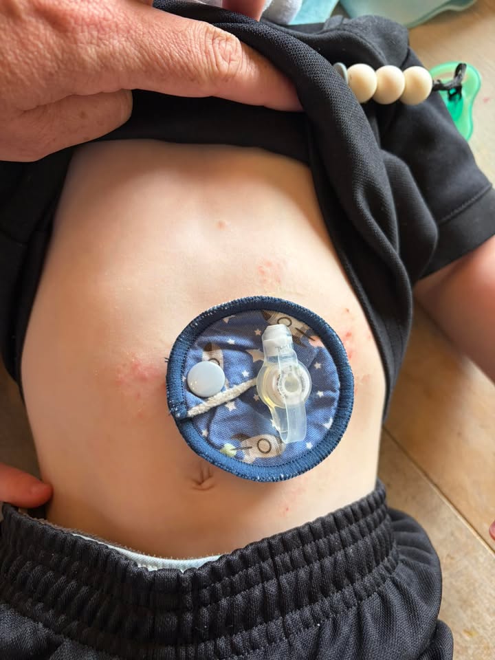 G Tube Pad x 3